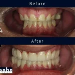 dental implants before after 2