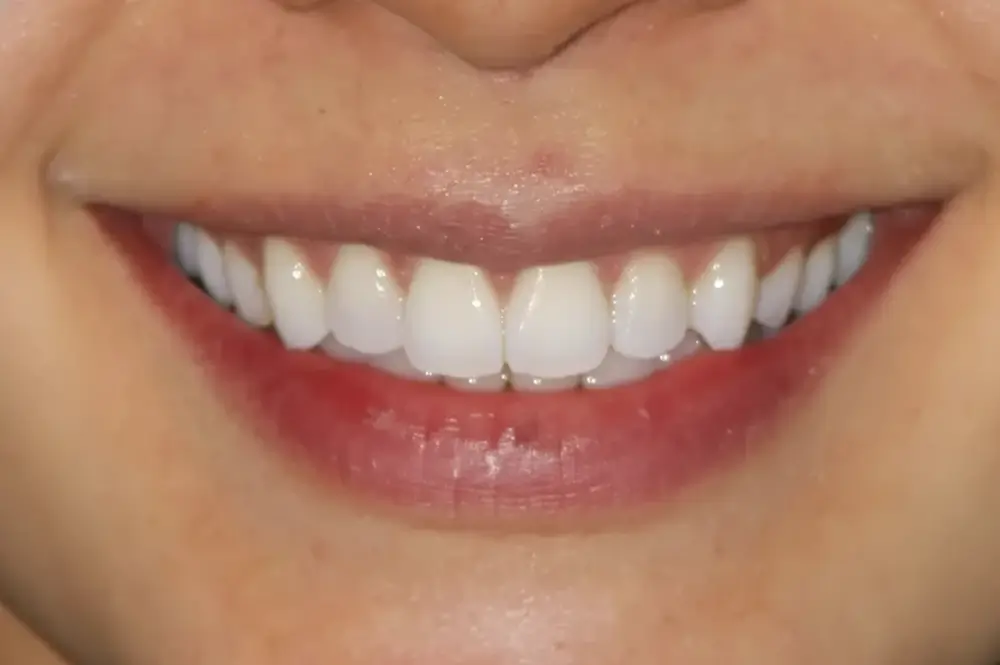 invisalign 1 after (1)