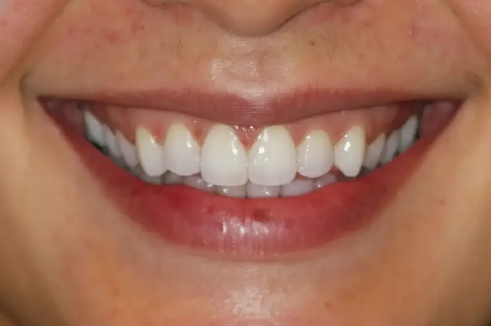 invisalign 1 before (1)