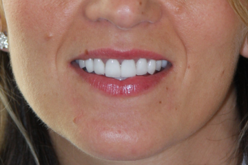 veneers 1 after