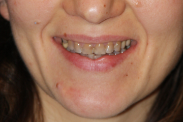 veneers 1 before