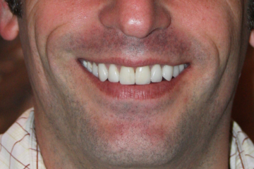 veneers 6 after