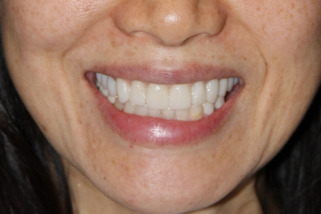 veneers 7 after
