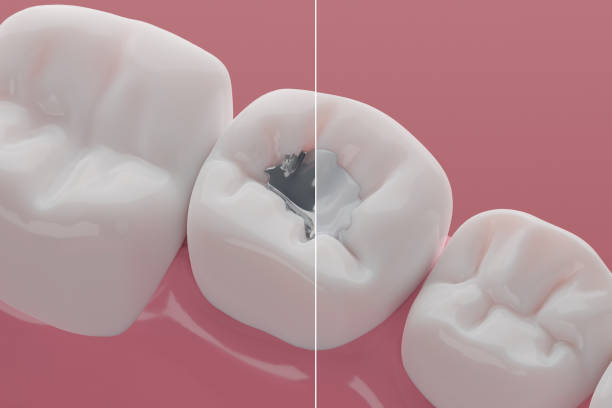 tooth with fillings
