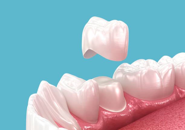 a digital illustration of a dental crown