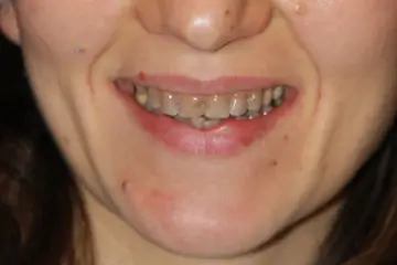 veneers 1 before (1)