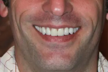 veneers 6 after (1)