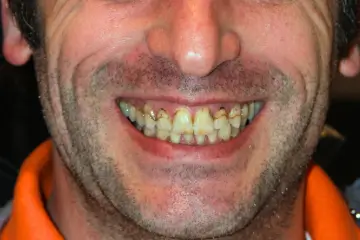 veneers 6 before (1)