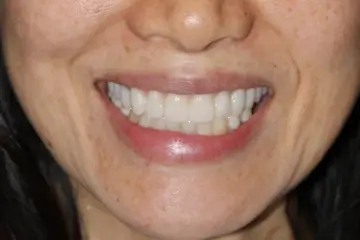 veneers 7 after (1)