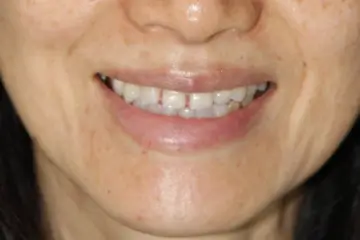 veneers 7 before (1)