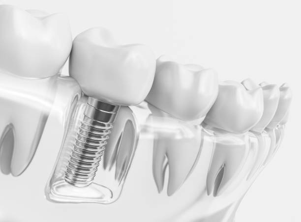 a photo showing a digital image of a dental implant