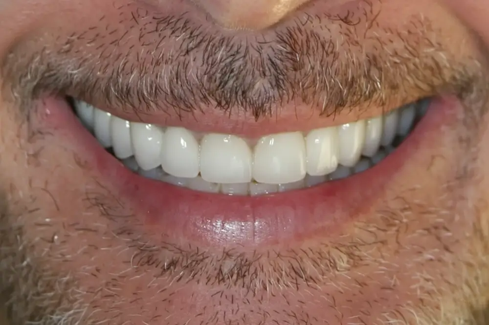 full mouth 1 after (1)