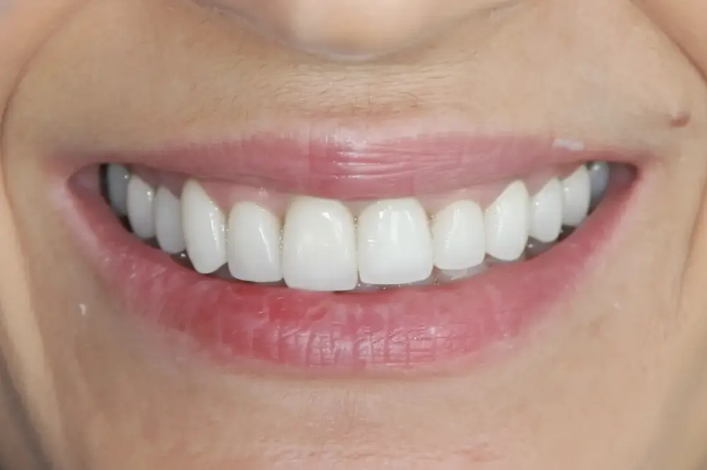 full mouth 8 after (1)